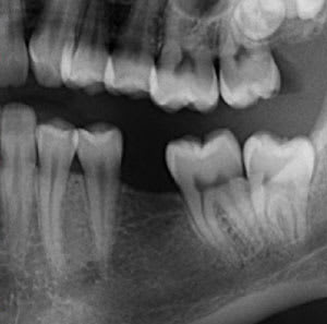 Dental Implants for Neighbouring Teeth X-Ray | West Market Dental | Calgary Dentist